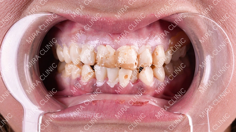 Enamel loss is permanent
